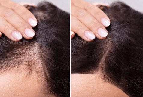 ReGenixal Hair Recover